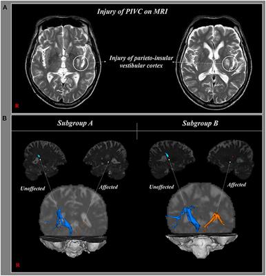 Associations Between Injury of the Parieto-Insular Vestibular Cortex and Changes in Motor Function According to the Recovery Process: Use of Diffusion Tensor Imaging